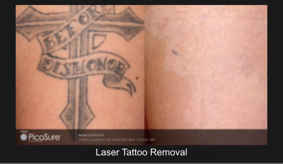 Picosure Laser Tattoo Removal Nazarian Plastic Surgery