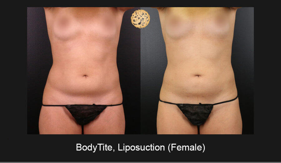 Bodytite Liposuction Female 1 Nazarian Plastic Surgery