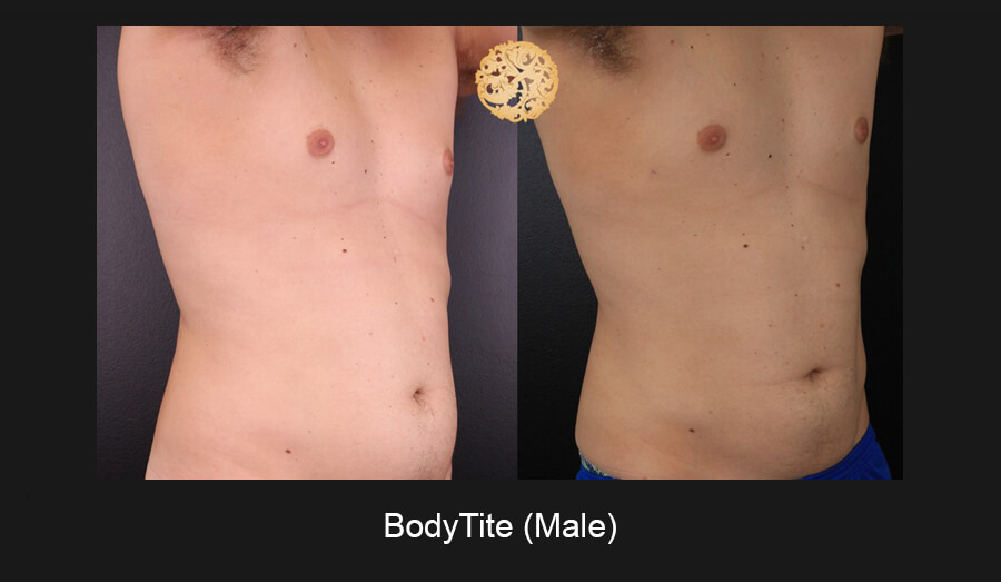 BodyTite – Before and After