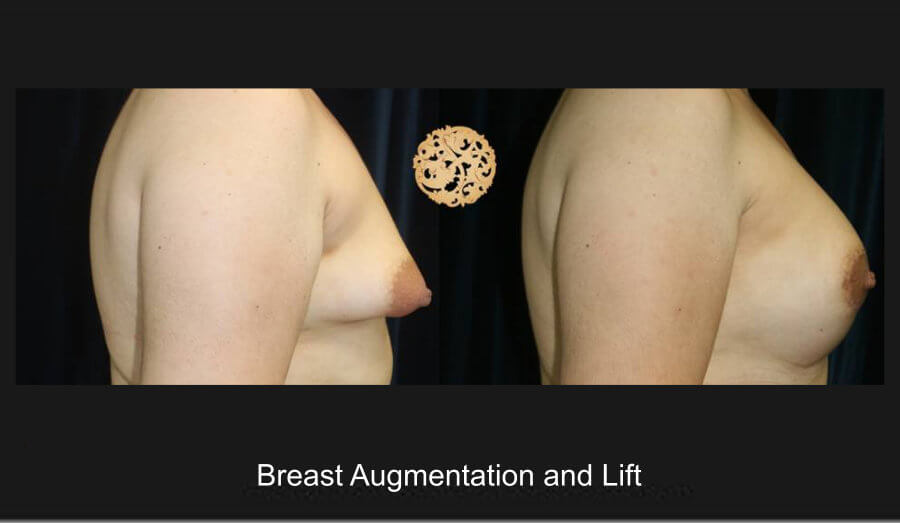 Breast Augmentation and Lift Gallery