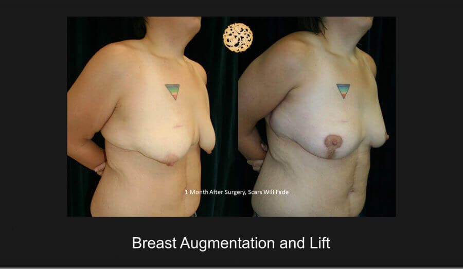 Breast Lift Gallery