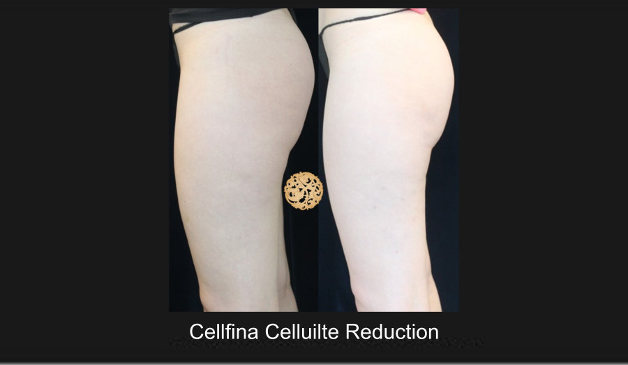 cellfina-2c