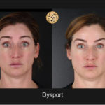 Dysport B Nazarian Plastic Surgery
