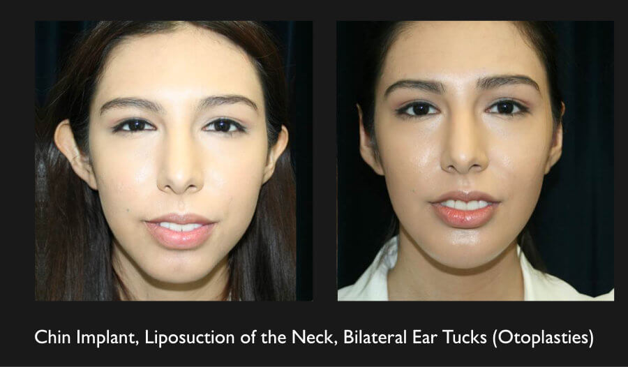 neck-liposuction