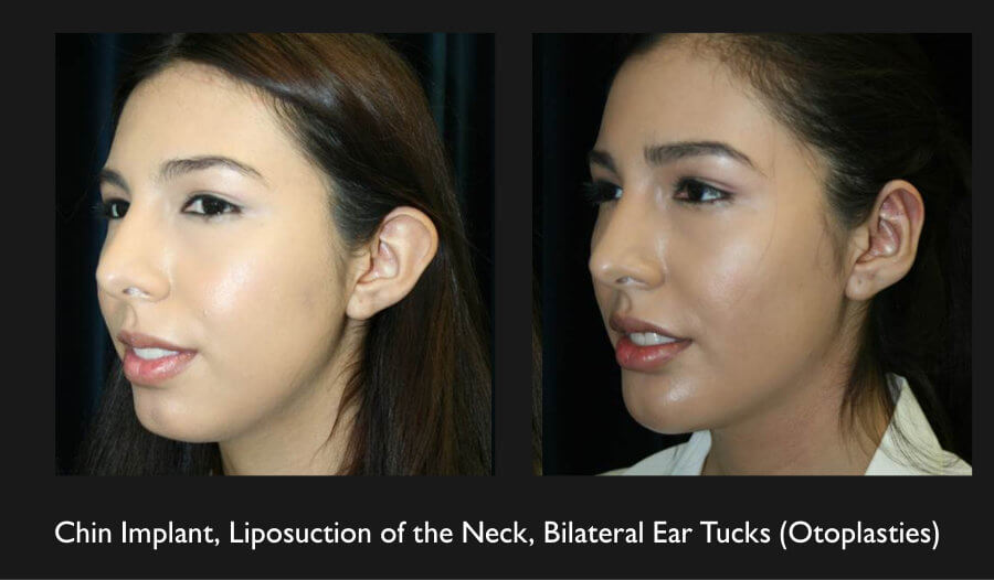 neck-liposuction-2