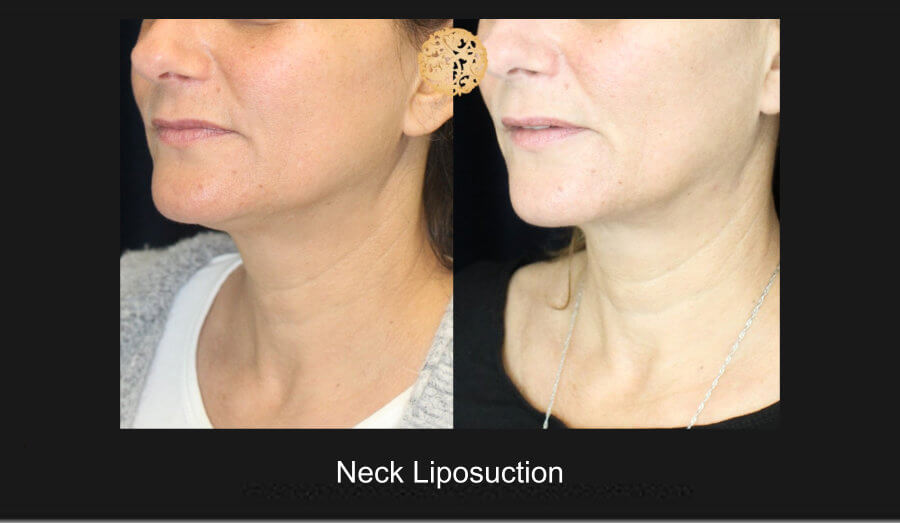 neck-liposuction-7