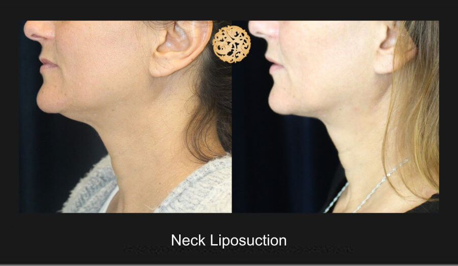 neck-liposuction-11