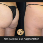 Ns Butt Aug A Nazarian Plastic Surgery
