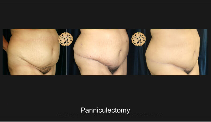 panniculectomy-1d