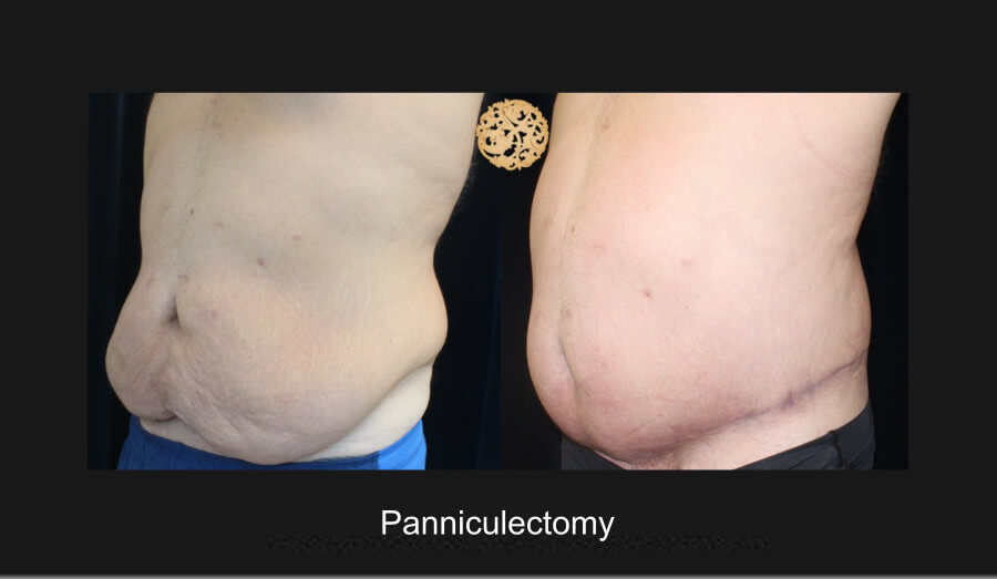 panniculectomy-3
