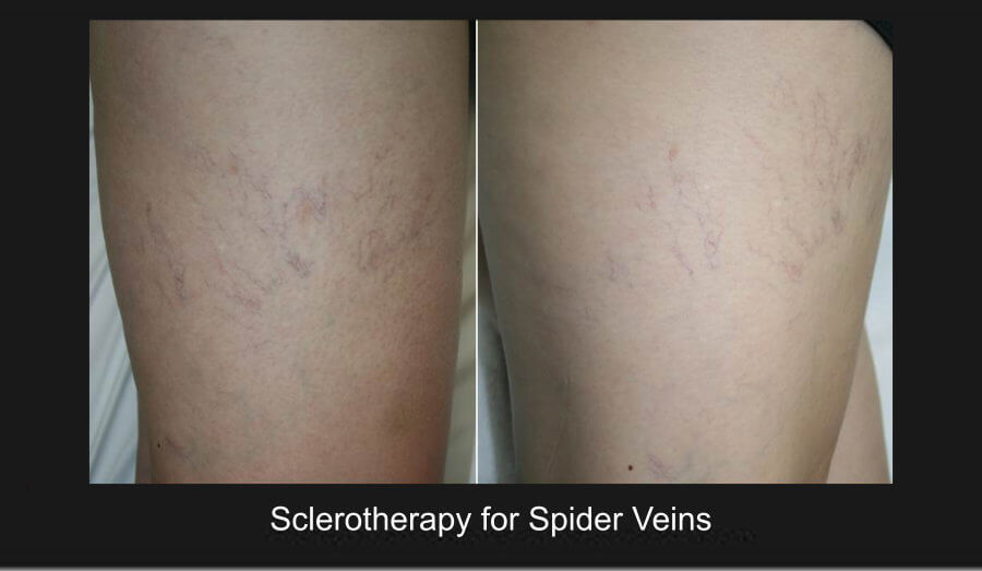 Sclerotherapy for Spider Veins Before and After Gallery