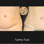 Tummy Tuck 1 Nazarian Plastic Surgery