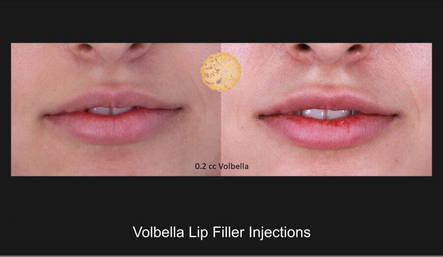 volbella-injections-a