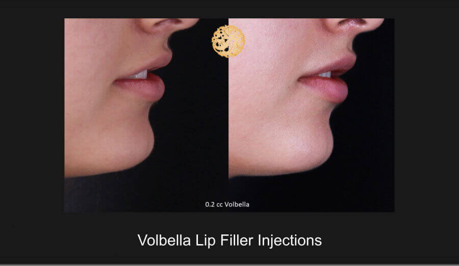 volbella-injections-e
