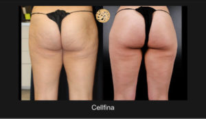Cellfina Treatment Showcasing Significant Cellulite Diminishment On Female Buttocks And Upper Legs, Before And After Images
