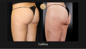 Comprehensive Cellfina Cellulite Reduction Outcome On Female Posterior Thighs, Juxtaposing Pre-Treatment Dimpling With Post-Treatment Smoothness