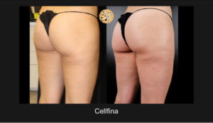 Dramatic Cellulite Reduction On Female Posterior Thighs And Buttocks Using Cellfina System Visible In Before And After Comparison Photographs