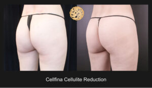Dramatic Before-And-After Comparison Of Female Cellulite Reduction Treatment, Showcasing Visible Skin Smoothing And Contouring Improvements