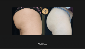 Before And After Results Of Cellfina Cellulite Treatment On Female Showing Significant Reduction In Skin Dimpling And Smoother Buttocks And Thighs