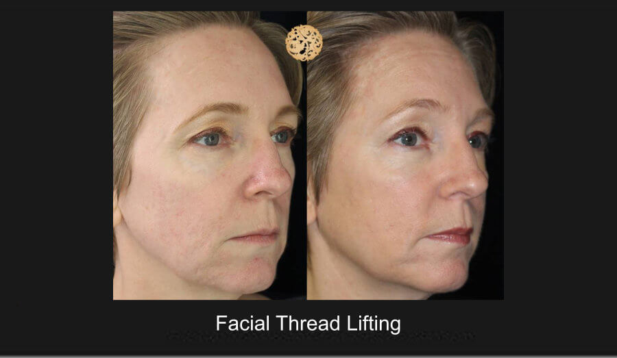 Facial Thread Lifting – Before and After Gallery