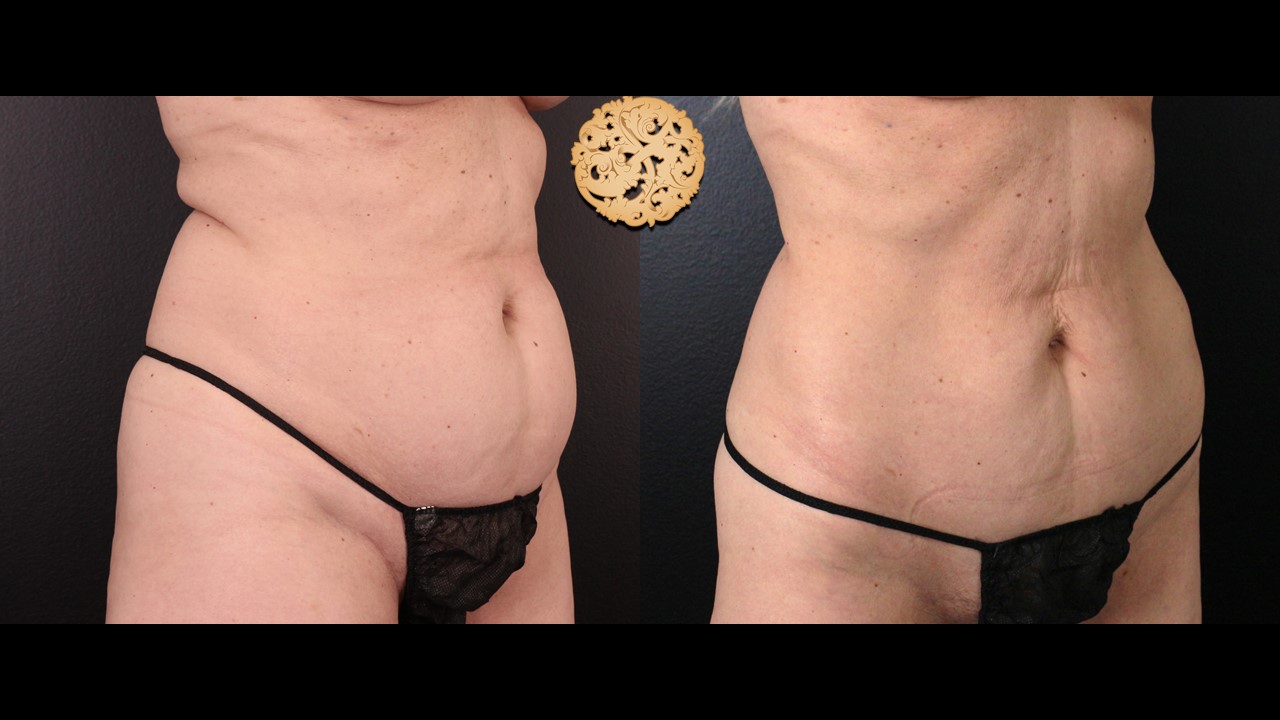 Coolsculpting Before and After Gallery | Abdomen/Flanks