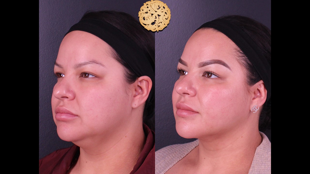 Buccal Fat Removal Before and After Gallery