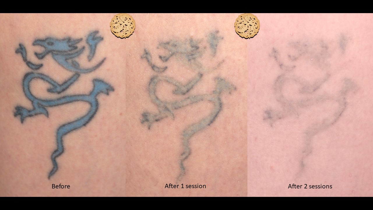 Laser Tattoo Removal Gallery