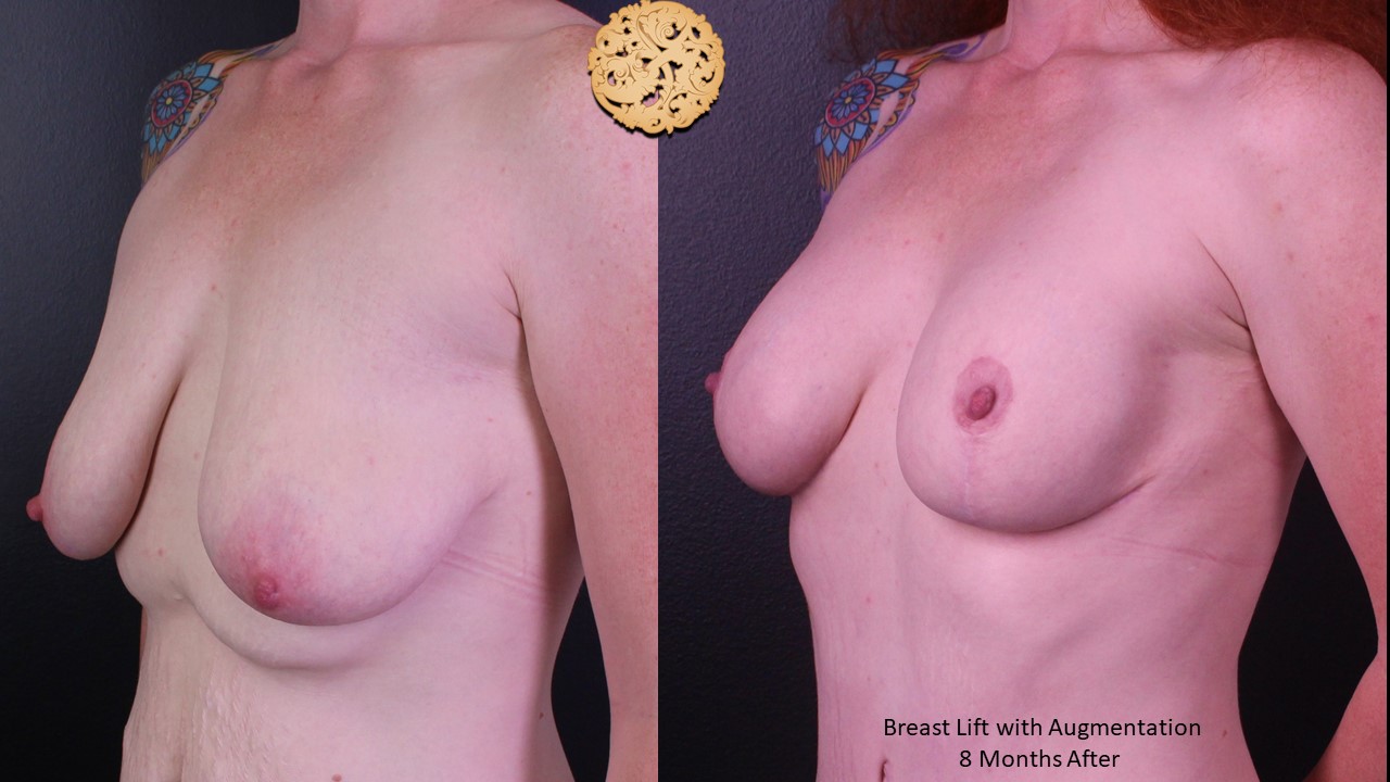 Breast Augmentation and Lift Gallery