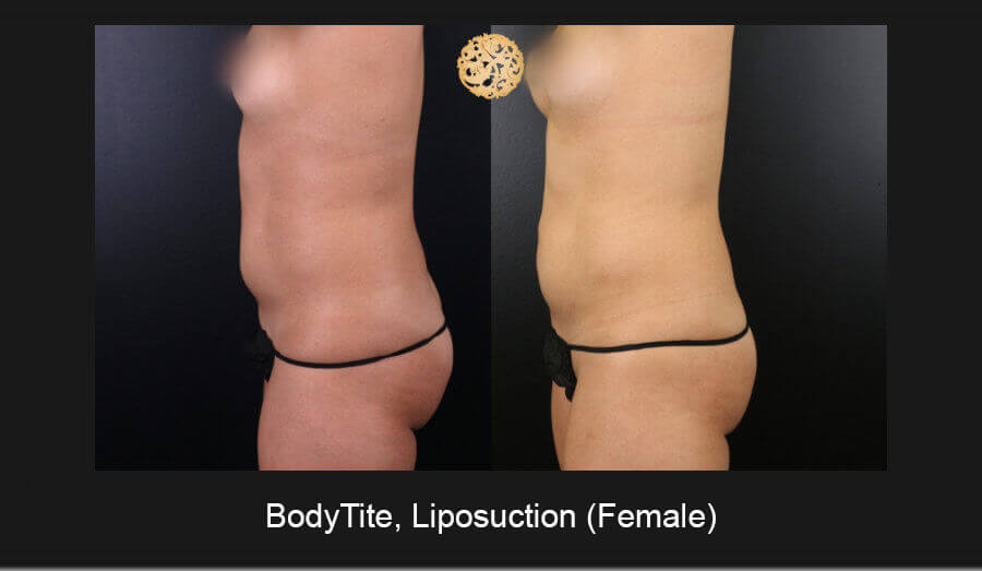 BodyTite-Liposuction-Female-4