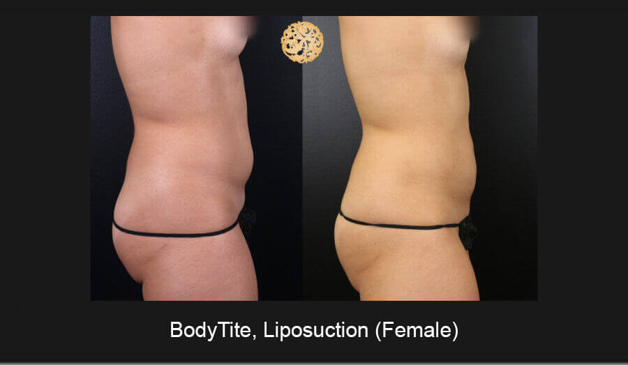 Bodytite-Liposuction-Female-5