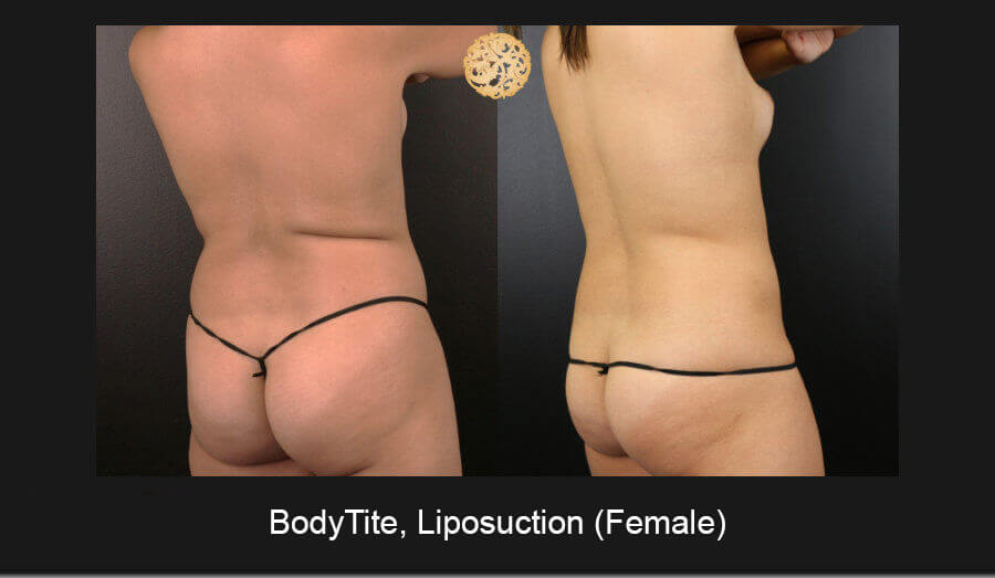 BodyTite-Liposuction-Female-6