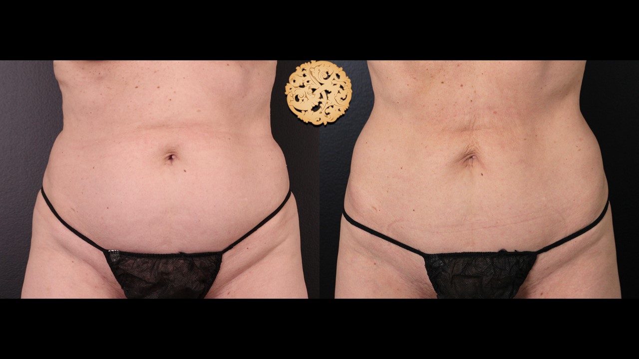 Coolsculpting Elite Abdominal Fat Reduction Revealing Flatter Stomach Results Nazarian Plastic Surgery