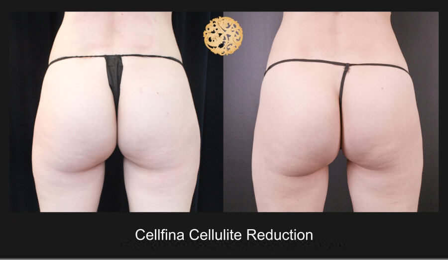 Cellfina Before And After Gallery