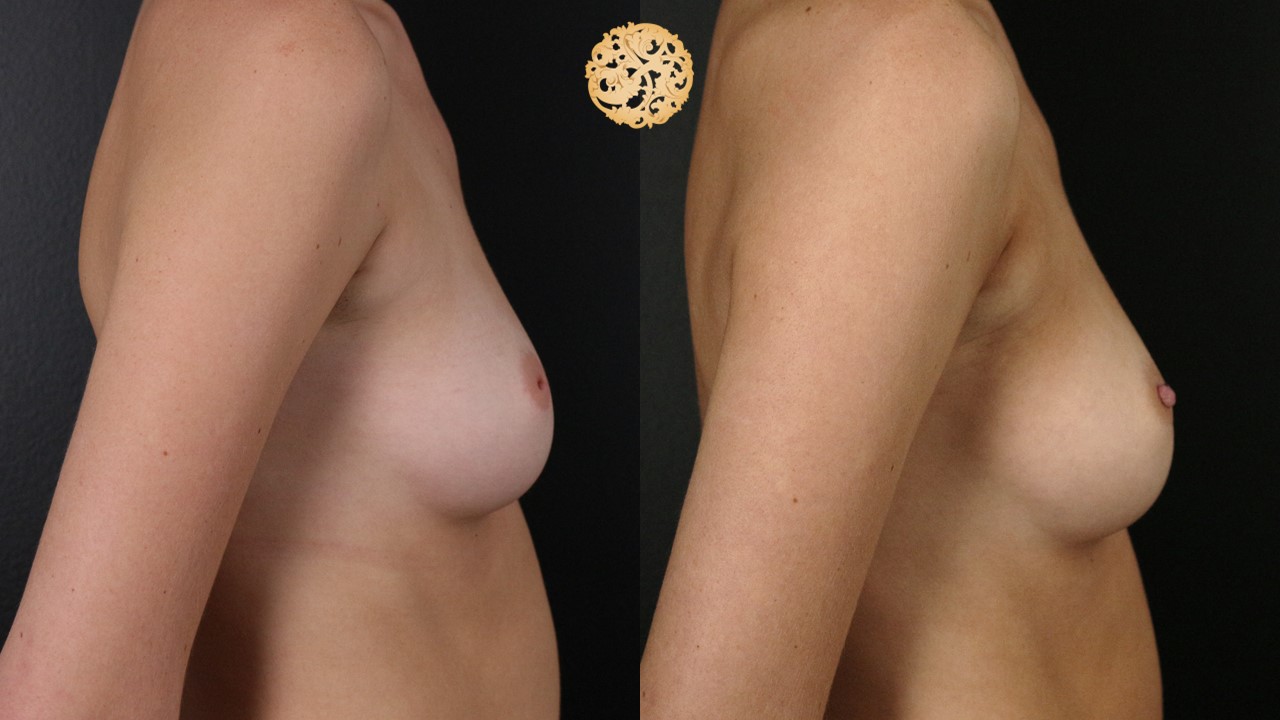Inverted Nipple Correction Gallery
