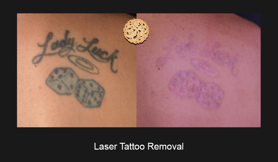 Laser-Tatto-Slide1