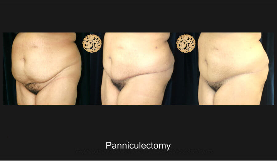 Panniculectomy - PHX Plastic Surgery
