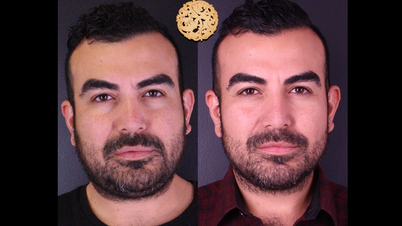 Vivace Before and After Gallery | Nazarian Plastic Surgery