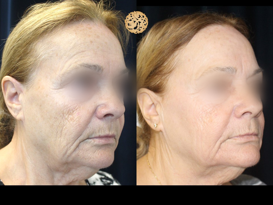 Halo Laser Treatment Gallery