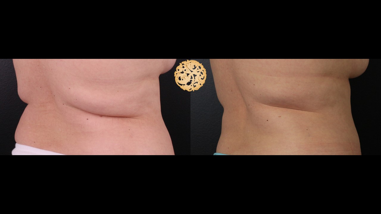 CoolSculpting Male Lower Abdomen Before After Pictures, Men Flanks Fat  removal
