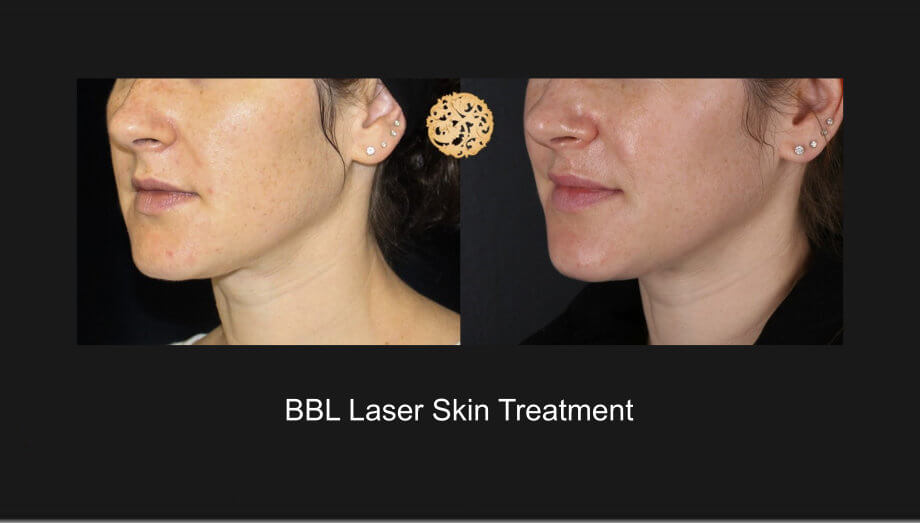 BBL Laser Skin Treatment Gallery