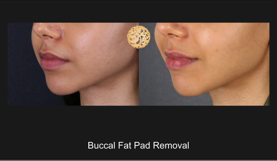 Buccal Fat Removal Before and After Gallery