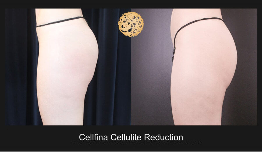 cellfina-1d