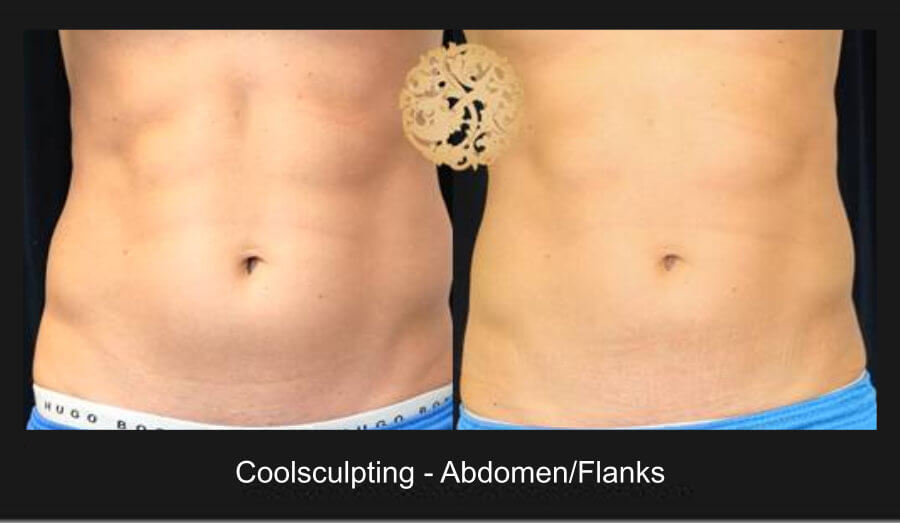 Coolsculpting Abs1A Nazarian Plastic Surgery