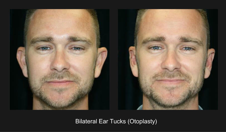 Nazarian Plastic Surgery - Ear Tuck or Otoplasty Beverly Hills