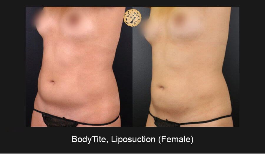 Female Bodytite Liposuction Results Nazarian Plastic Surgery