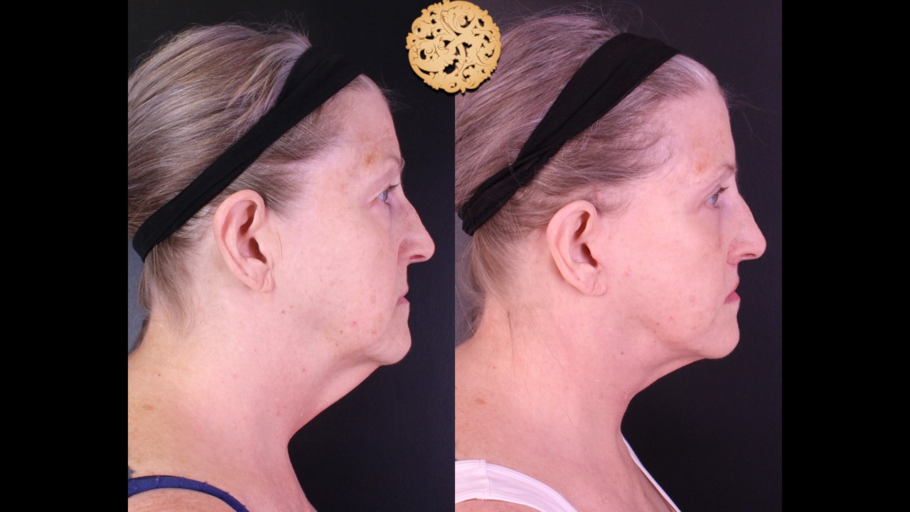 Face Lift and Neck Lift Gallery