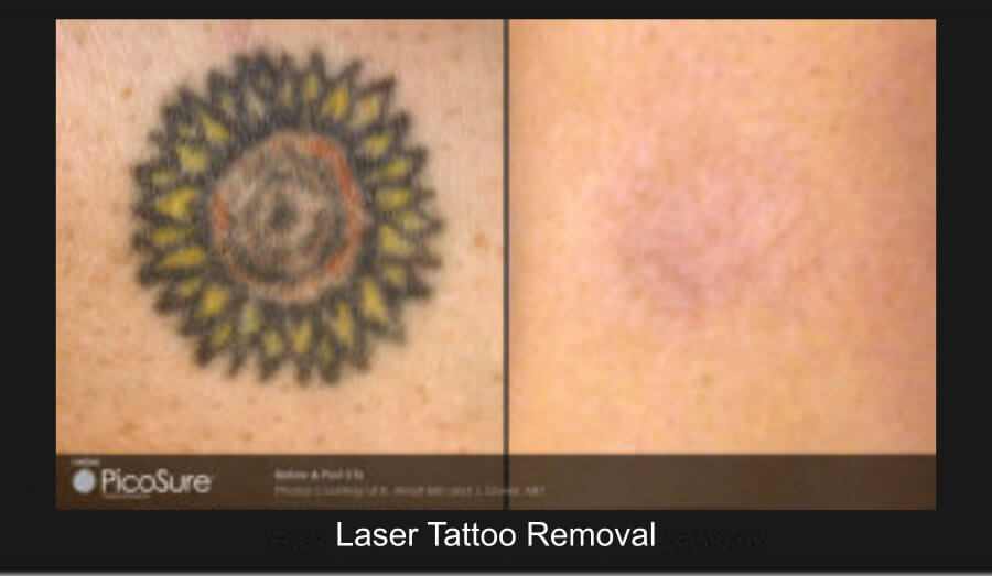 laster_removal_10