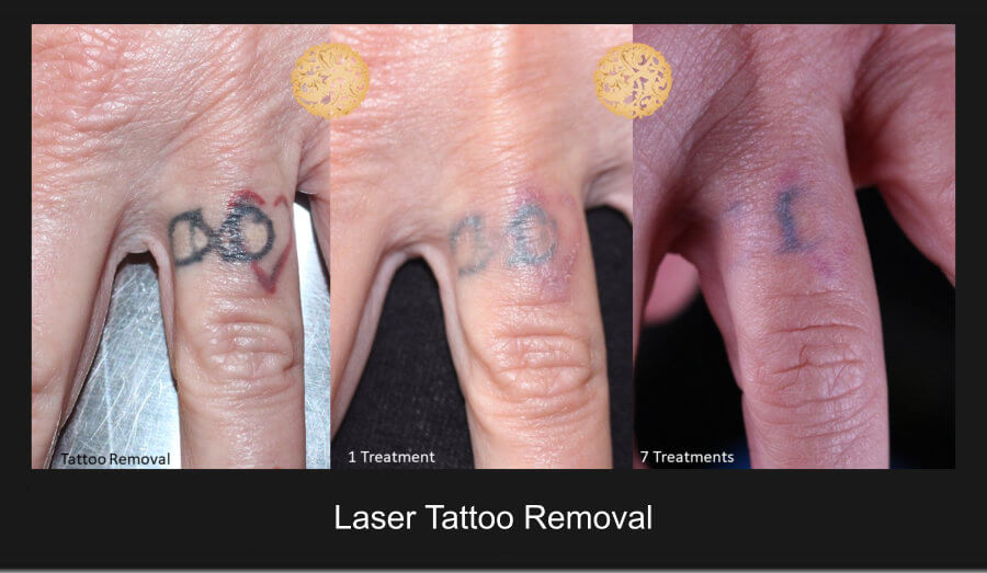 Laser Tattoo Removal Gallery | Nazarian Plastic Surgery