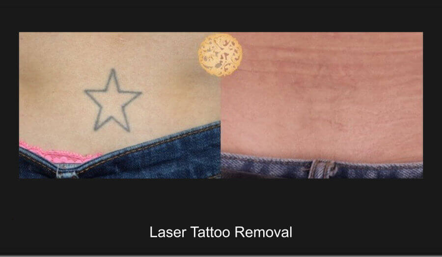 Laser Tattoo Removal Gallery