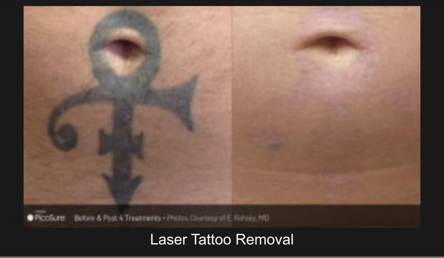 laster_removal_6